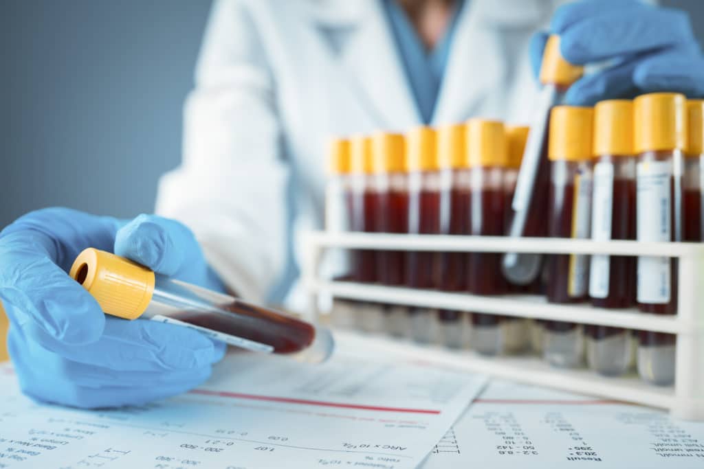 Laboratory result with blood tubes Blood Test, Blood, Medical Sample, Test Tube